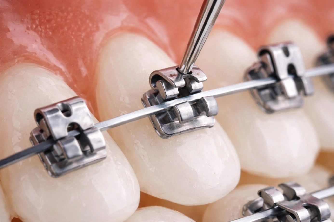 Self-Ligating Brackets (เช่น Damon)