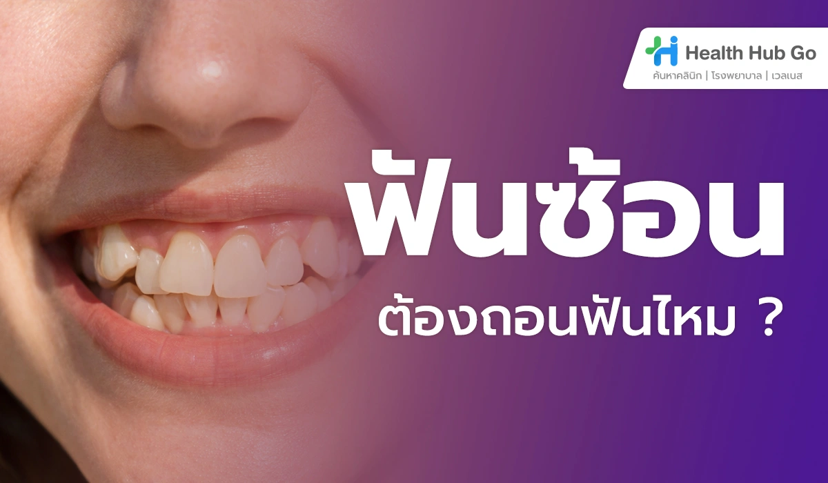 ฟันซ้อนต้องถอนฟันไหม เข้าใจเหตุผลก่อนตัดสินใจจัดฟัน