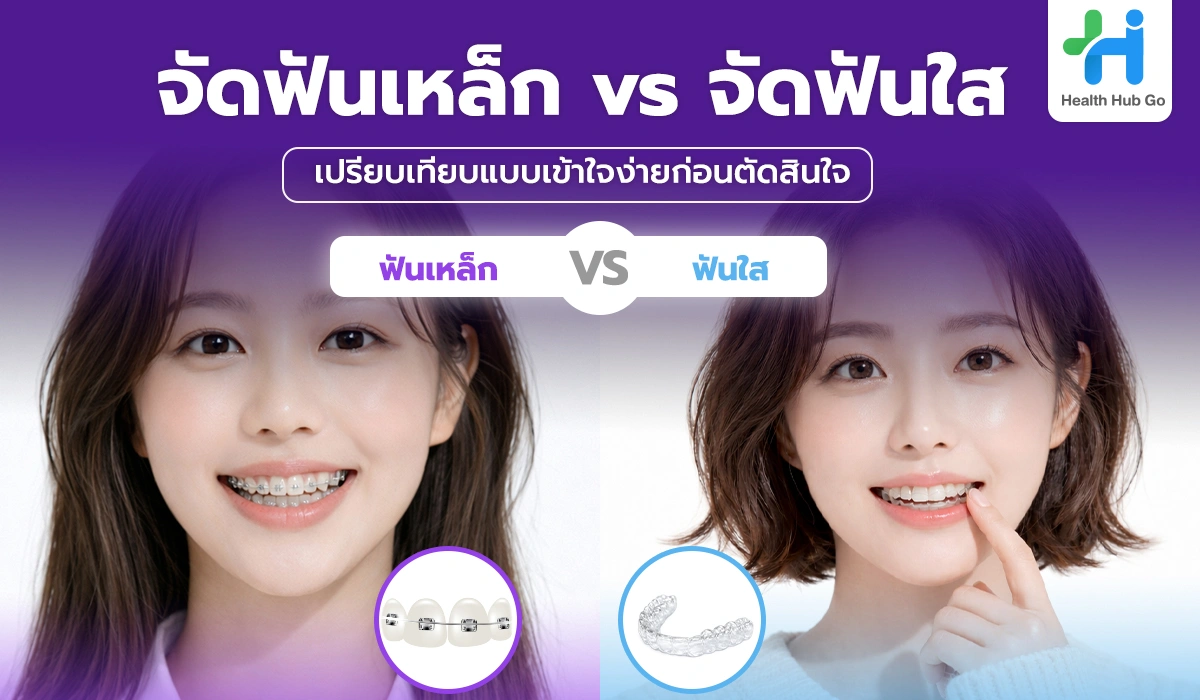 จัดฟันเหล็ก vs จัดฟันใส เลือกแบบไหนดี เปรียบเทียบแบบเข้าใจง่ายก่อนตัดสินใจ