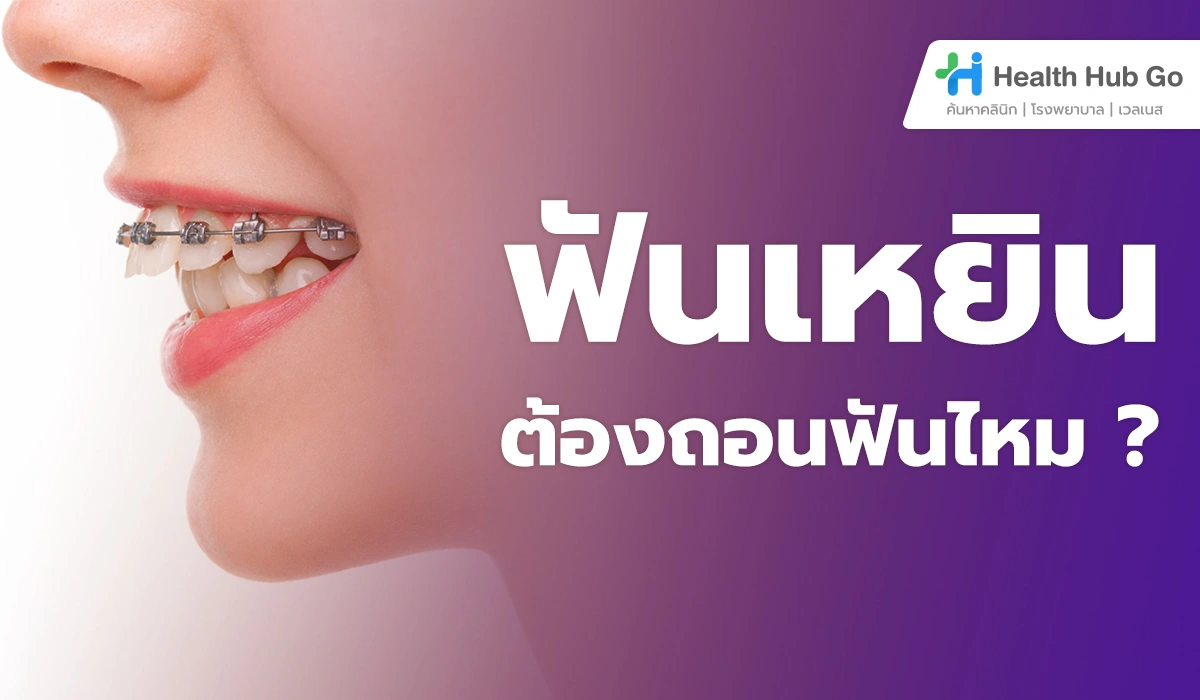 ฟันเหยินต้องถอนฟันไหม เข้าใจเหตุผลก่อนตัดสินใจจัดฟัน