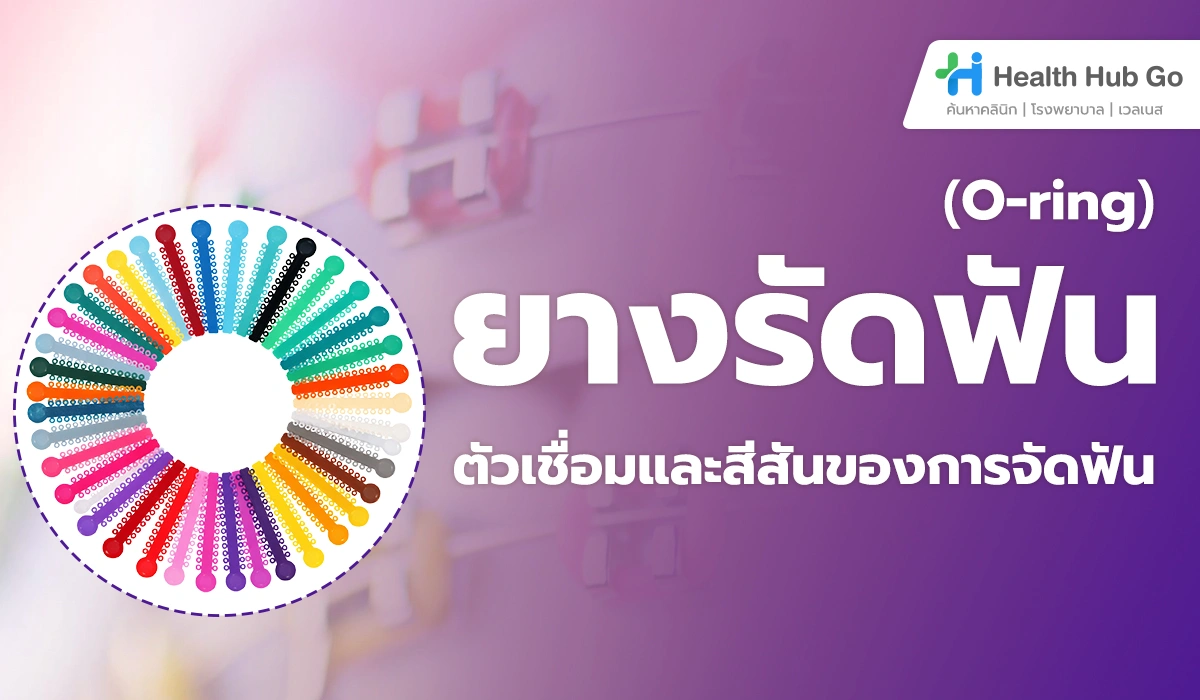 O-ring (ยางจัดฟัน) คืออะไร : ตัวเชื่อมสำคัญและสีสันของการจัดฟัน