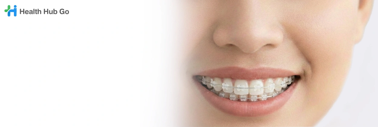 จัดฟันเซรามิก