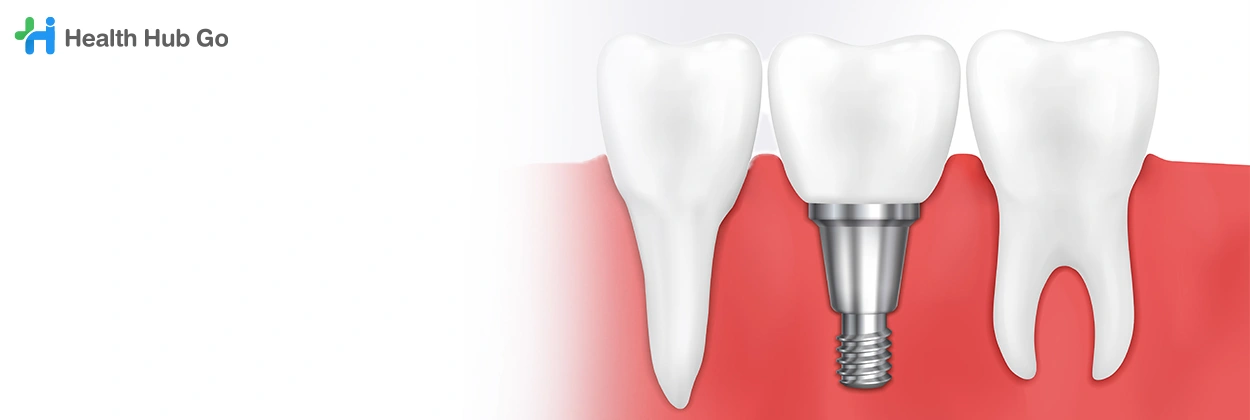 รากฟันเทียม