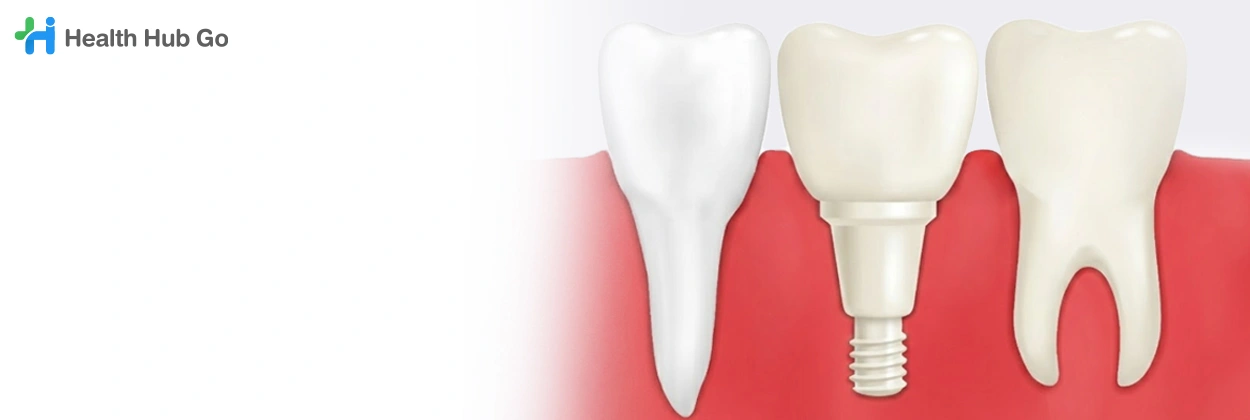  รากฟันเทียมเซรามิก