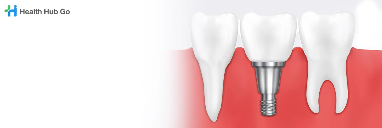 รากฟันเทียมไทเทเนียม