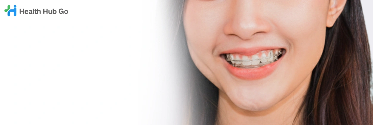 รีเทนเนอร์แบบลวด (โลหะ)