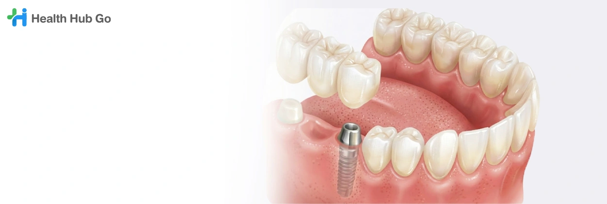 สะพานฟัน
