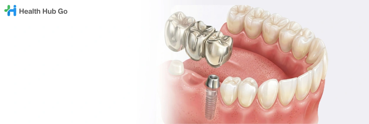 สะพานฟันโลหะล้วน