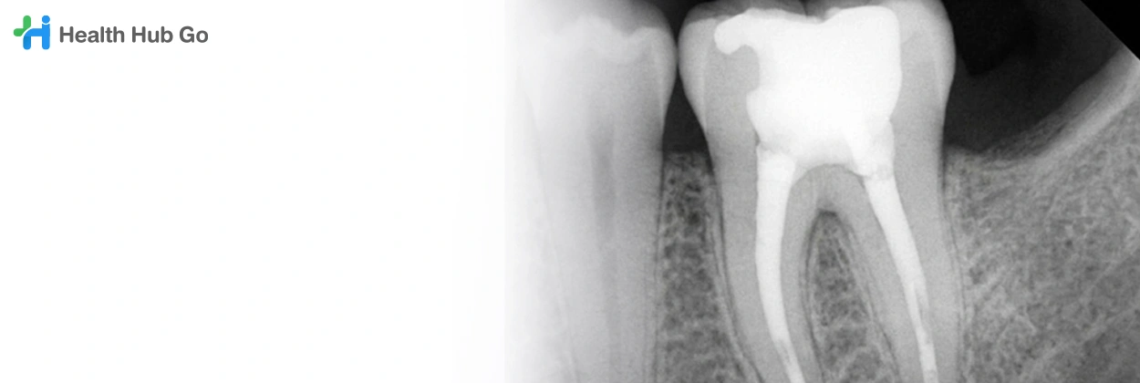 เอกซเรย์ฟันเฉพาะซี่