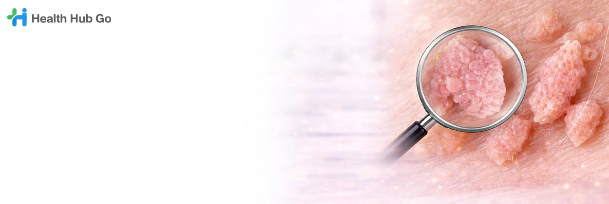 รักษาหูดหงอนไก่