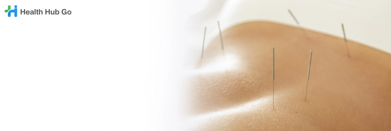 ฝังเข็ม