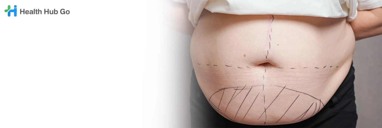 ผ่าตัดก้อนไขมัน