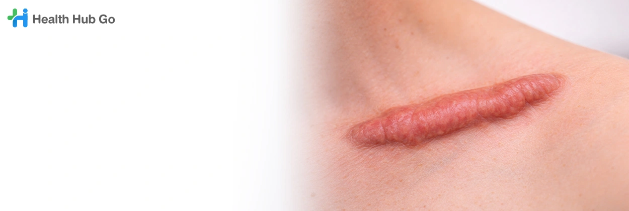 ผ่าตัดคีลอยด์