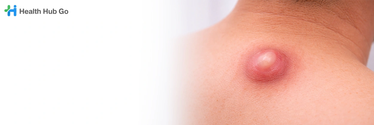 ผ่าตัดซีสต์