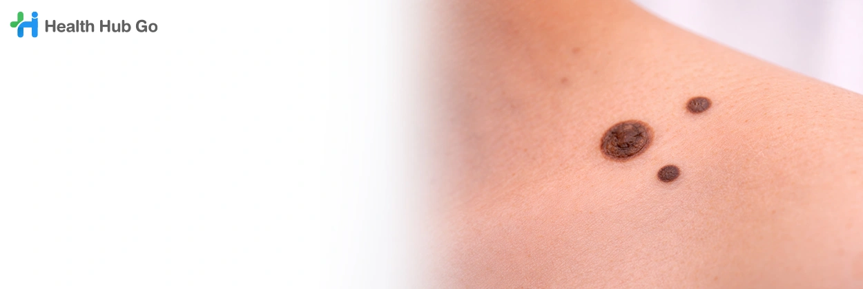 ผ่าตัดไฝ