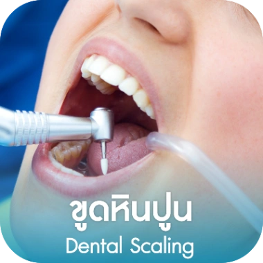 ขูดหินปูน