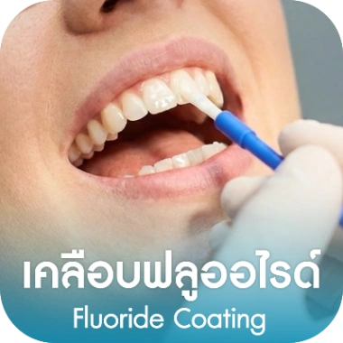 เคลือบฟลูออไรด์