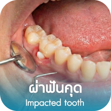 ผ่าฟันคุด