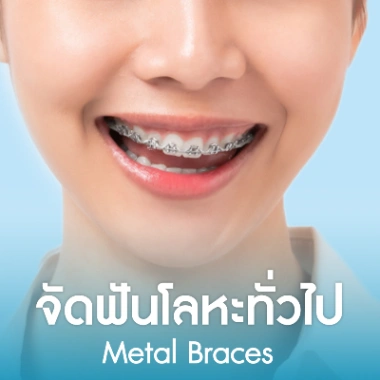 จัดฟันเหล็ก (โลหะ)