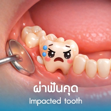 ผ่าฟันคุด