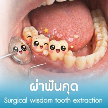 ผ่าฟันคุด