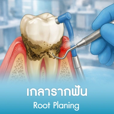 เกลารากฟัน