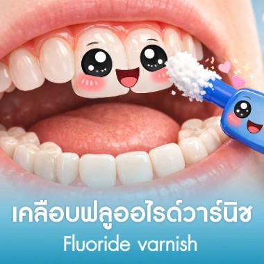 เคลือบฟลูออไรด์วาร์นิช