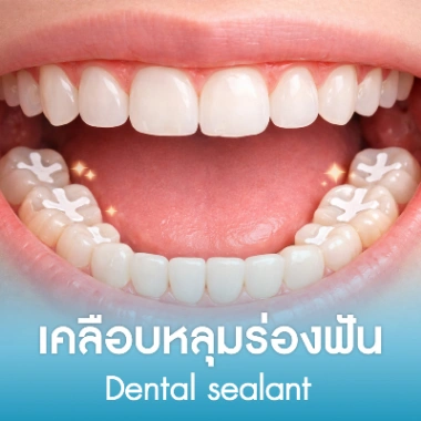 เคลือบหลุมร่องฟัน