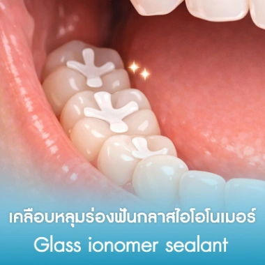 เคลือบหลุมร่องฟันกลาสไอโอโนเมอร์