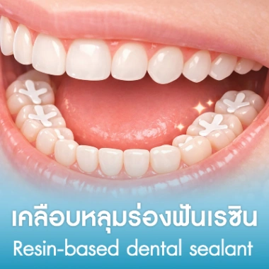 เคลือบหลุมร่องฟันเรซิน