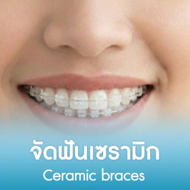 จัดฟันเซรามิก