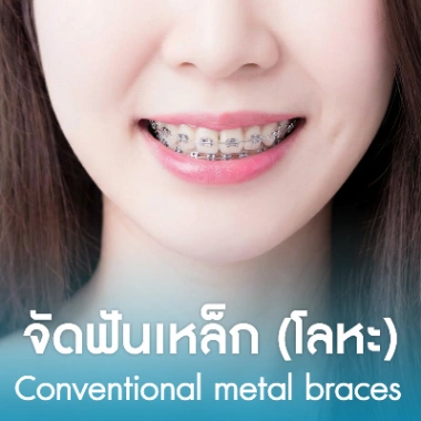 จัดฟันเหล็ก (โลหะ)