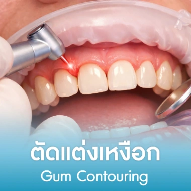 ตัดแต่งเหงือก