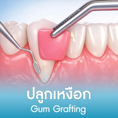 ปลูกเหงือก