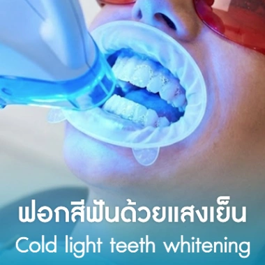 ฟอกสีฟันด้วยแสงเย็น