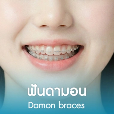 จัดฟันดามอน