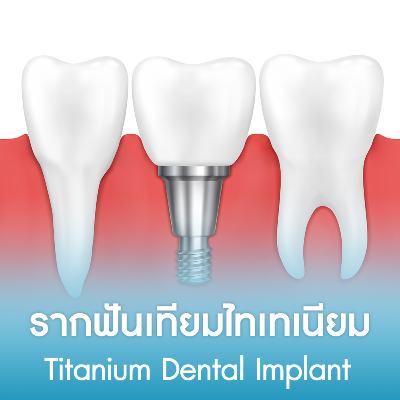 รากฟันเทียมไทเทเนียม