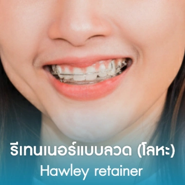 รีเทนเนอร์แบบลวด (โลหะ)