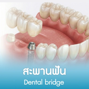 สะพานฟัน