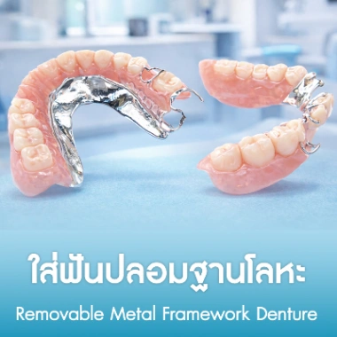 ใส่ฟันปลอมฐานโลหะ