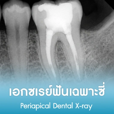เอกซเรย์ฟันเฉพาะซี่