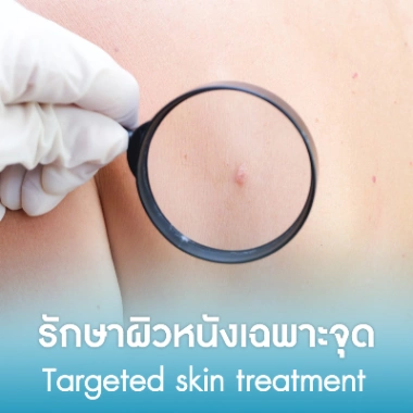 รักษาผิวหนังเฉพาะจุด