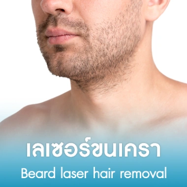 เลเซอร์ขนเครา