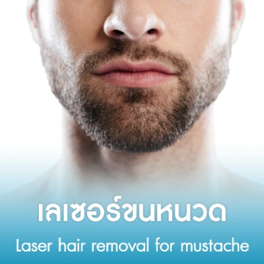 เลเซอร์ขนหนวด