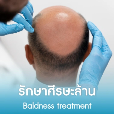 รักษาศีรษะล้าน