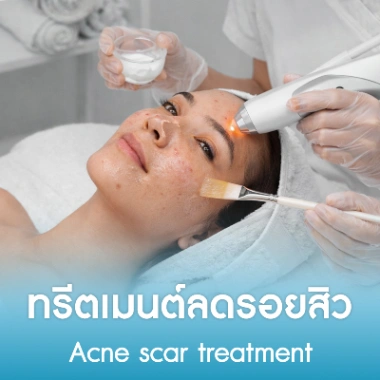 ทรีตเมนต์ลดรอยสิว
