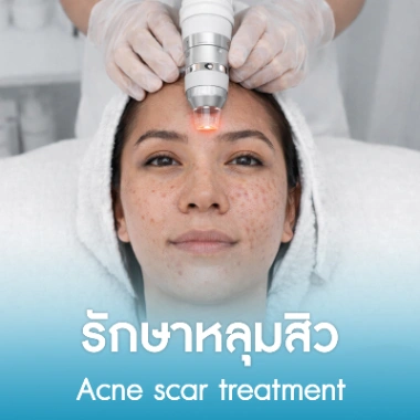 รักษาหลุมสิว