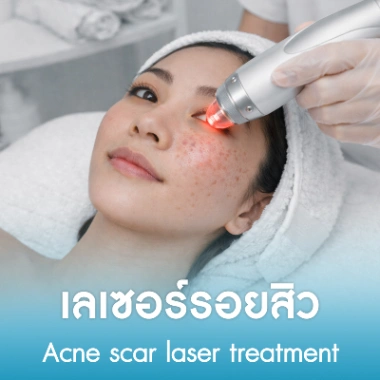 เลเซอร์รอยสิว