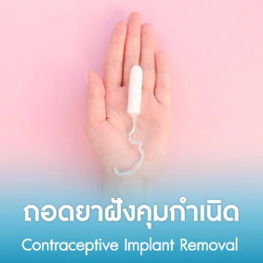 ถอดยาฝังคุมกำเนิด