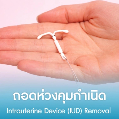 ถอดห่วงคุมกำเนิด
